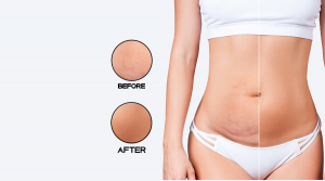 Liposuction Can Help You to Get Your Shape Back