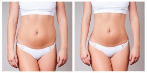 Liposuction Can Help You to Get Your Shape Back