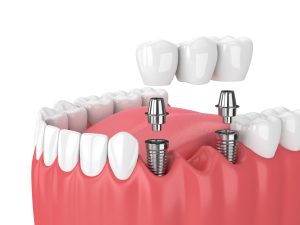 Dentist Supports